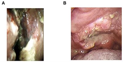 Extranodal Natural Killer/T-Cell Lymphoma, Nasal Type: Basic Science and Clinical Progress